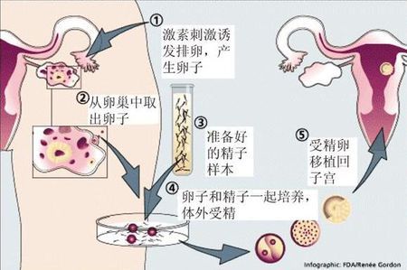 男性因素